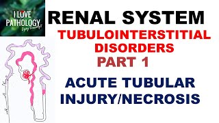 ACUTE TUBULAR INJURYNECROSIS or ACUTE KIDNEY INJURY  Pathology [upl. by Hen]