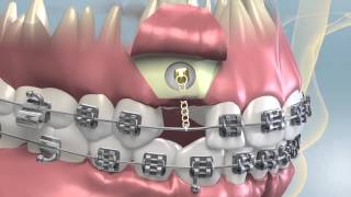 Impacted Tooth Exposure amp Uncovering For Orthodontics [upl. by Lynch458]