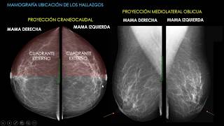 Mamografía Parte 1 [upl. by Ellessig]