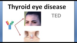 Ophthalmology 423 Thyroid Eye Disease Graves Exophthalmos Proptosis NOSPECS Classification Cause [upl. by Ellinehc518]