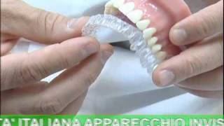 ODONTOIATRIA Invisalign  Apparecchio Invisibile [upl. by Anaud192]