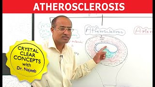 Atherosclerosis  Pathophysiology [upl. by Olumor361]