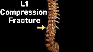 L1 Compression Fracture Spinal Challenge 제1요추 압박골절 척추의 도전 [upl. by Eelnayr]