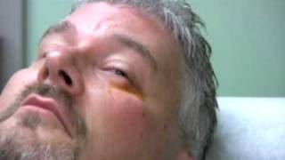 Chalazion Injection Demonstration [upl. by Retloc]