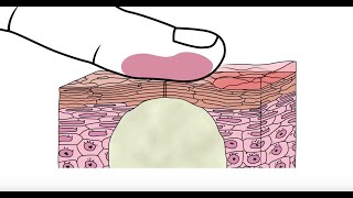 Using glycolic acid to help clear acne  Acneorg [upl. by Aivataj18]