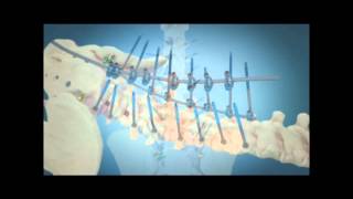 Scoliosis Surgical Correction with Instrumentation [upl. by Lankton485]